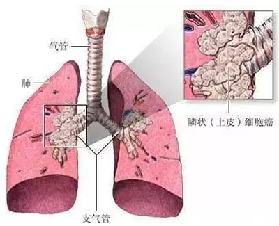 一文读懂非小细胞型肺癌和小细胞肺癌