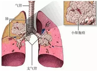 一文读懂非小细胞型肺癌和小细胞肺癌