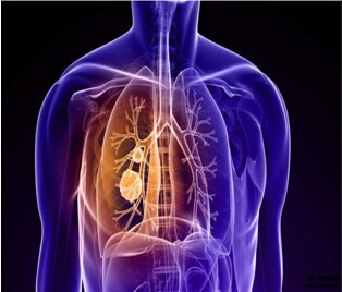 羅氏Tecentriq免疫組合療法一線治療肺癌，有望今年獲批